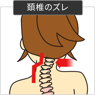 頸椎のズレが分かるイラスト図