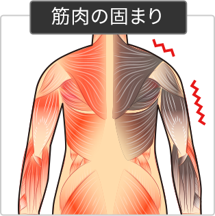 筋肉の固まり図