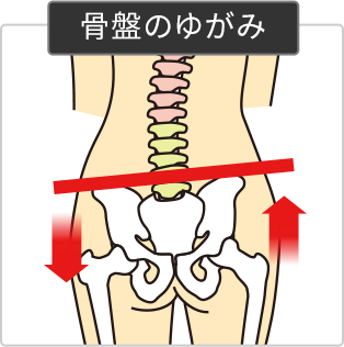 骨盤の歪みのを表しているイラスト