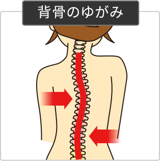 背骨の歪みイラスト図